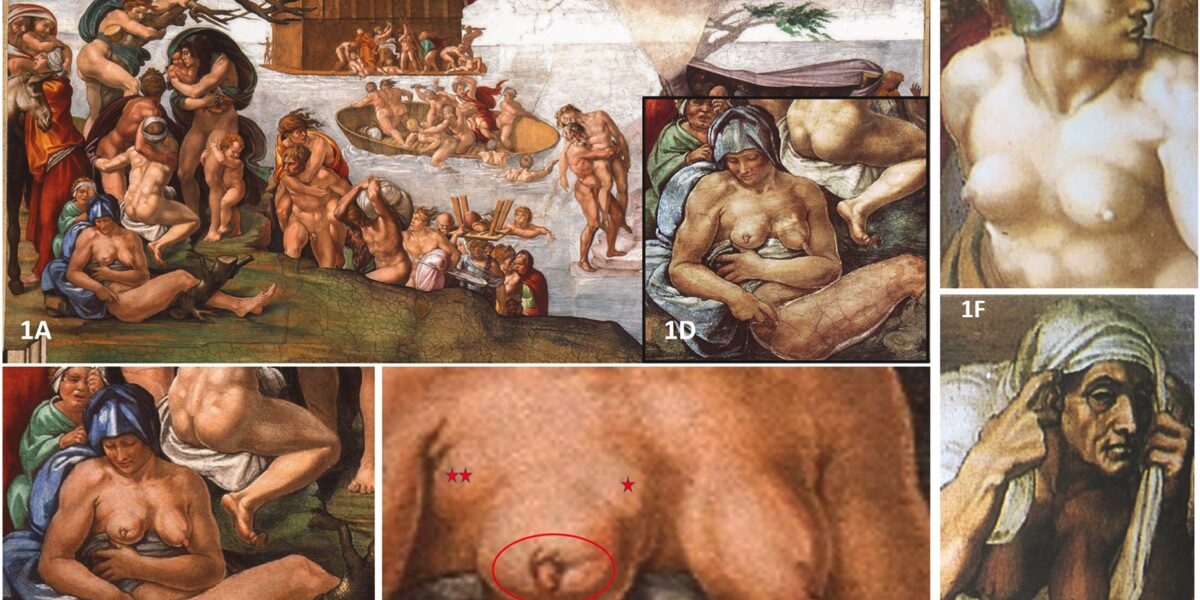 Immagine della donna raffigurata da Michelangelo nel Giudizio Universale con alcuni segni che suggerirebbero un cancro al seno © Bianucci The Breast